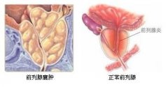 前列腺炎怎么治疗才会好