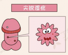 得了尖锐湿疣怎么治疗
